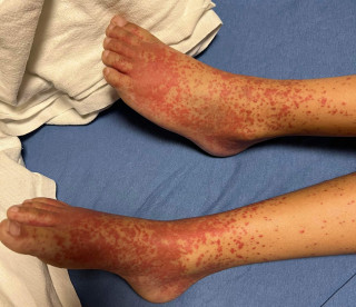 Childhood IGA Vasculitis ( Henoch Schonlein Purpura)